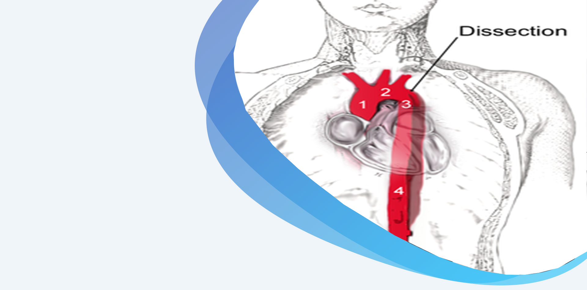 Aortic Dissection Artery And Vein Vrogue Co